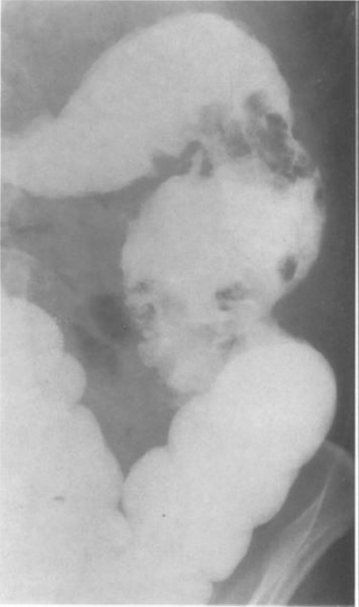 Lavement baryté montrant des pseudopolypes de la muqueuse