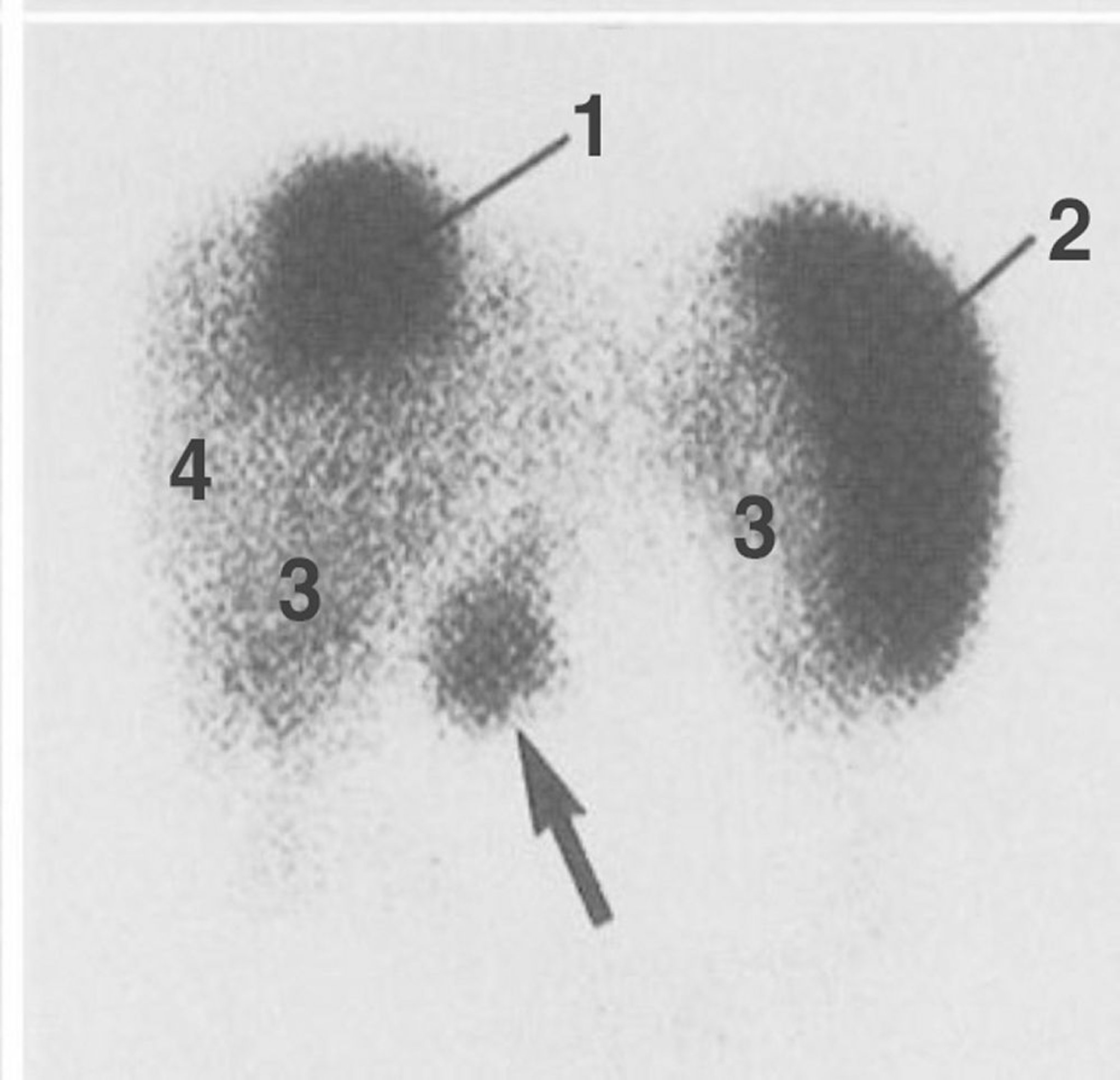 Gammagrafía con receptores de somatostatina (gammagrafía con octreotida) que muestra el sitio del tumor primario, que es un gastrinoma, y las metástasis