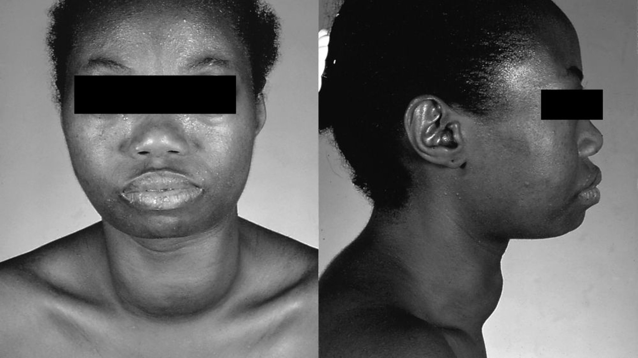 Graves Disease (Enlarged Thyroid Gland)