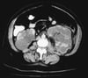 CT Axial View of Polycystic Kidneys