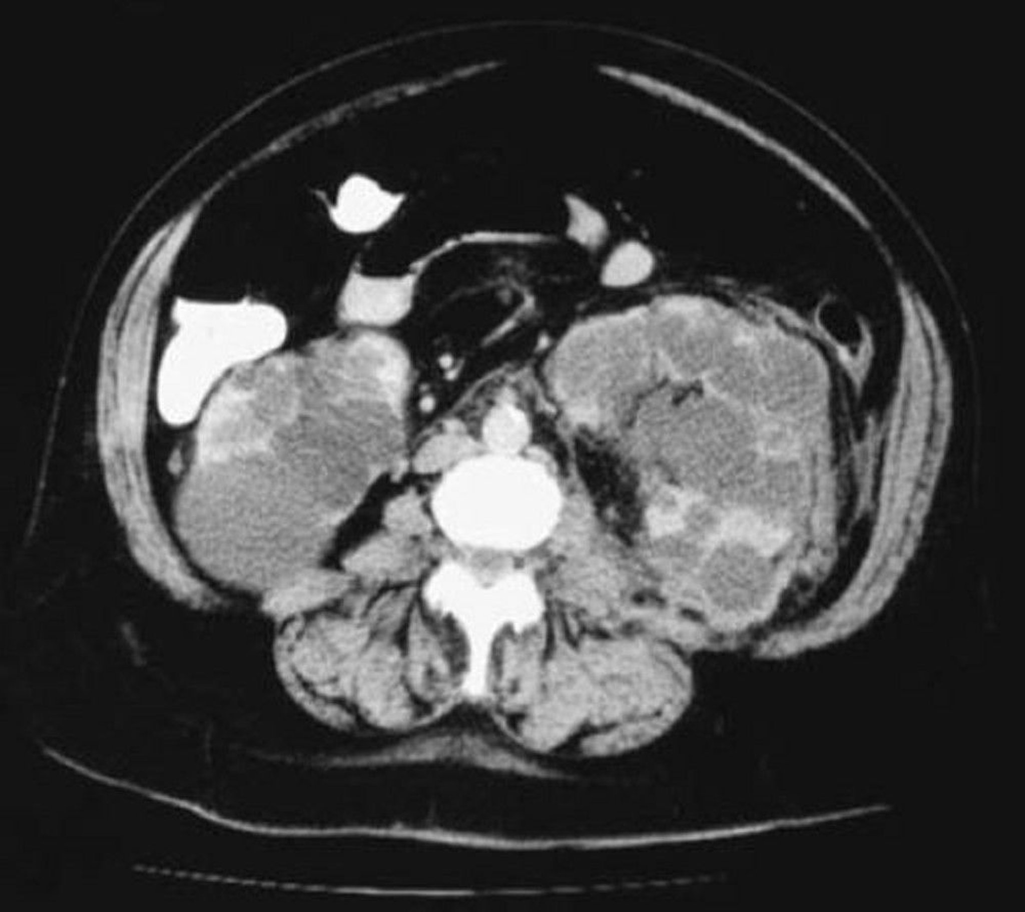 CT Axial View of Polycystic Kidneys