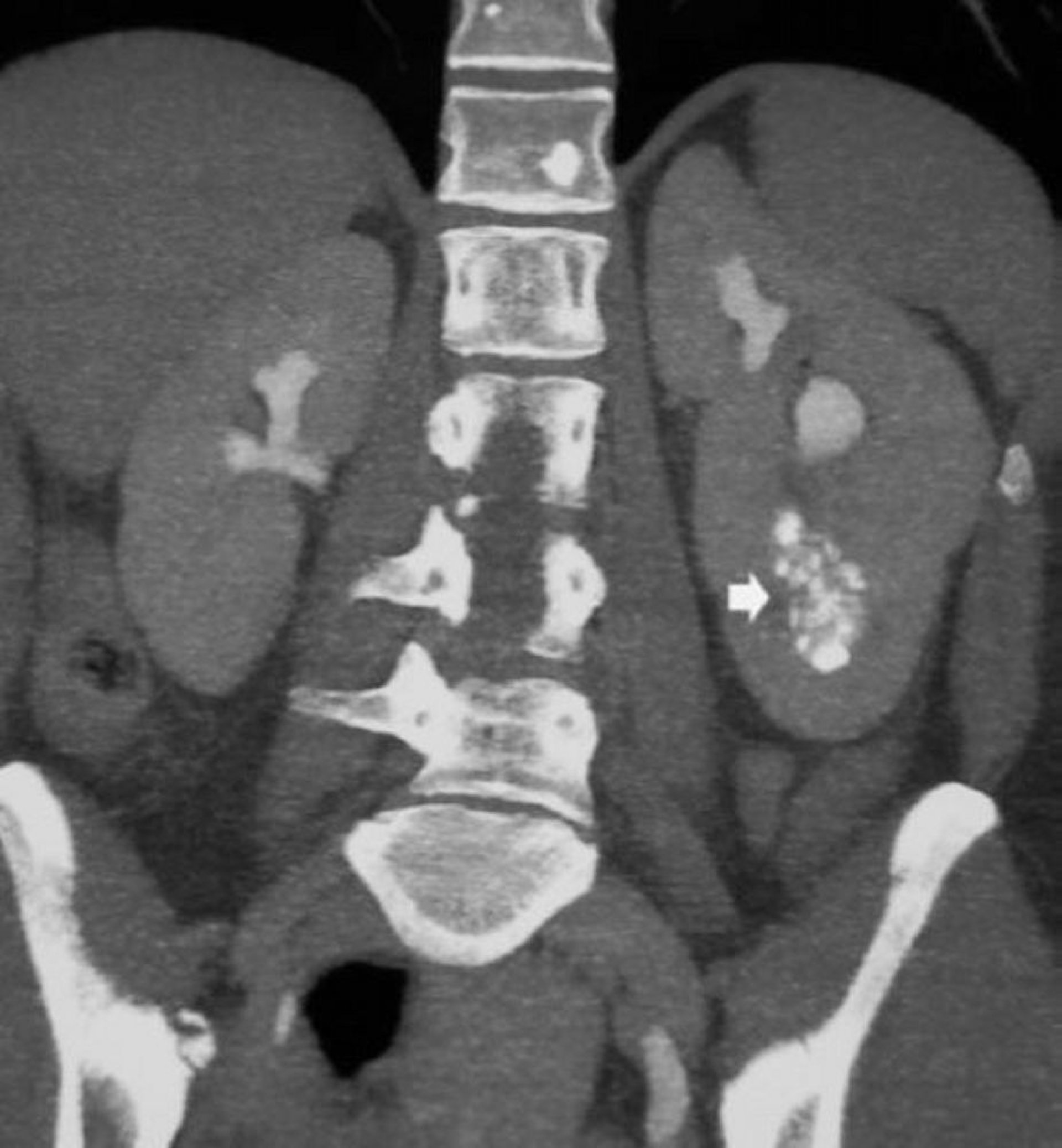 TDM coronale sans contraste montrant une néphrocalcinose médullaire