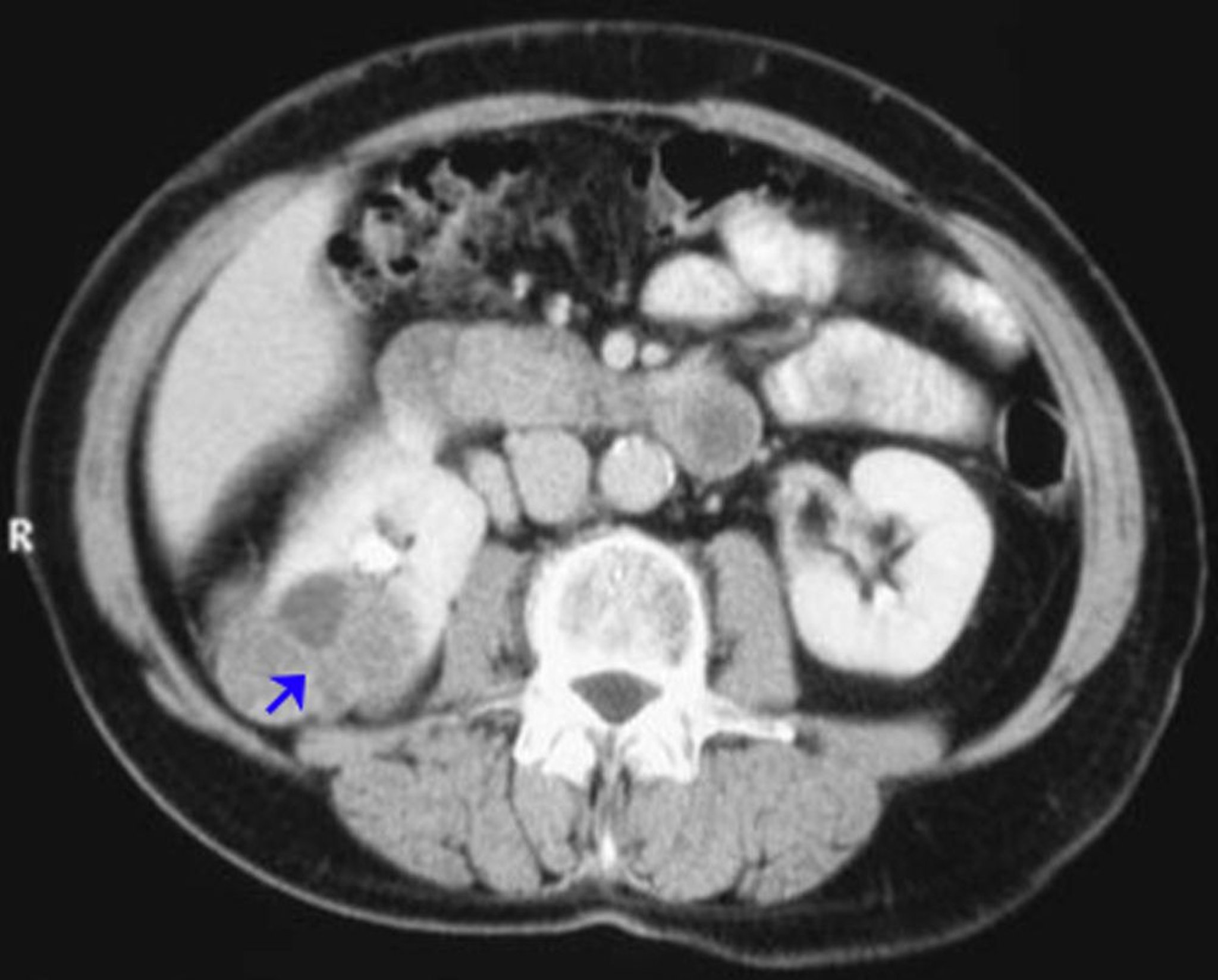 Renal Cell Carcinoma (Contrast CT Scan)