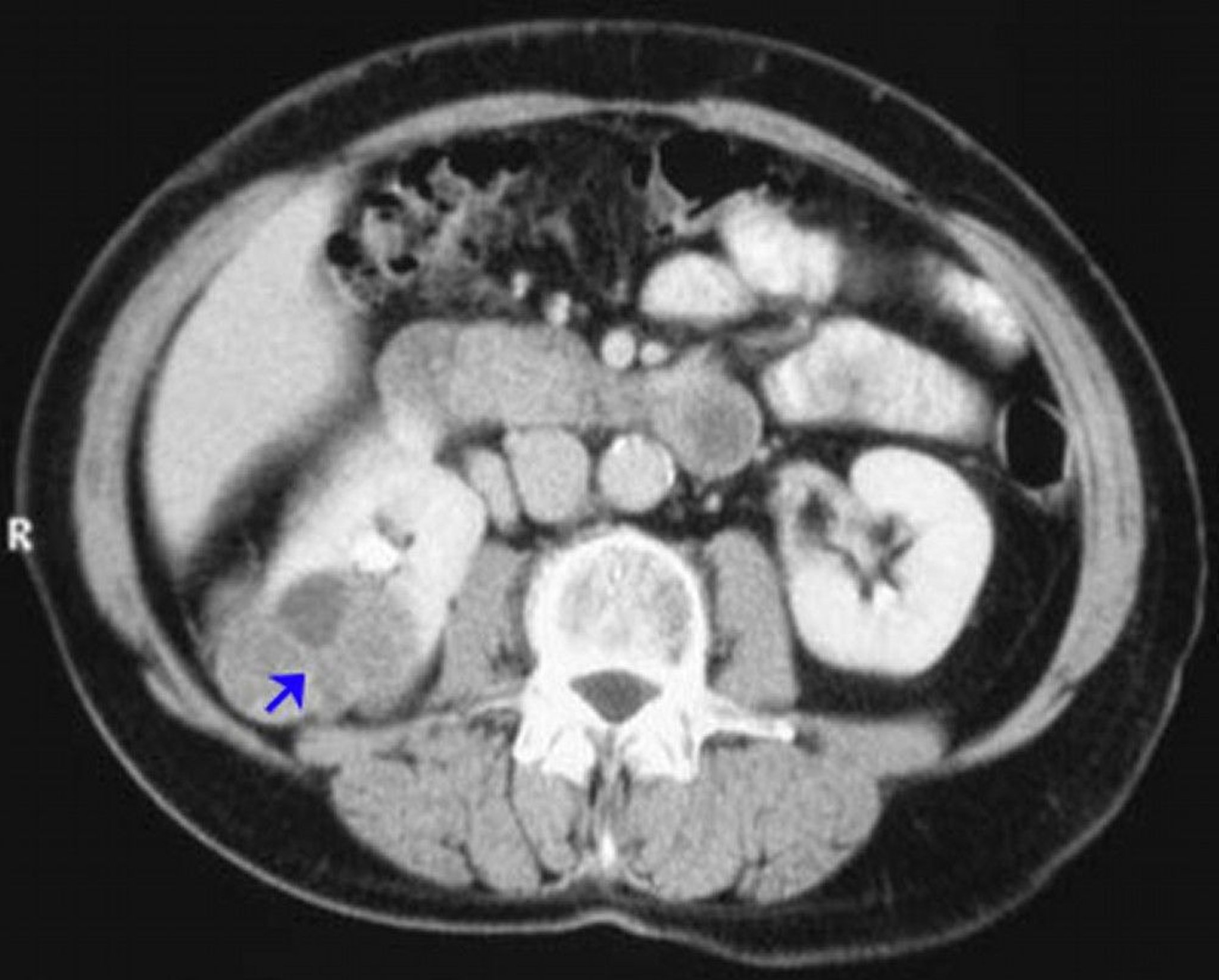 Carcinome à cellules rénales (TDM avec contraste)