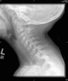 Traqueítis bacteriana (radiografía)