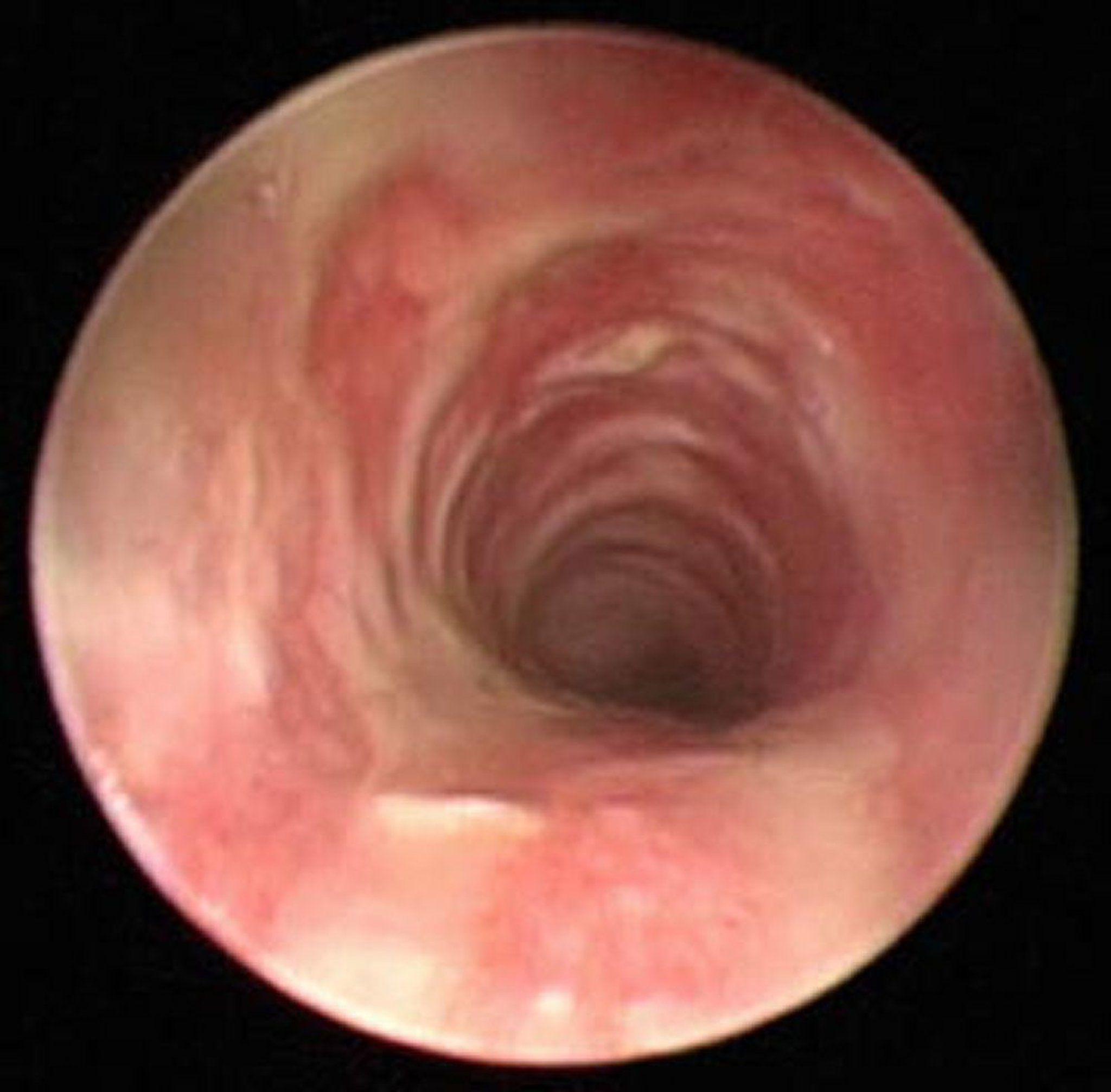 Traqueítis bacteriana (endoscopia)