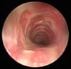 Tracheite batterica (endoscopia)