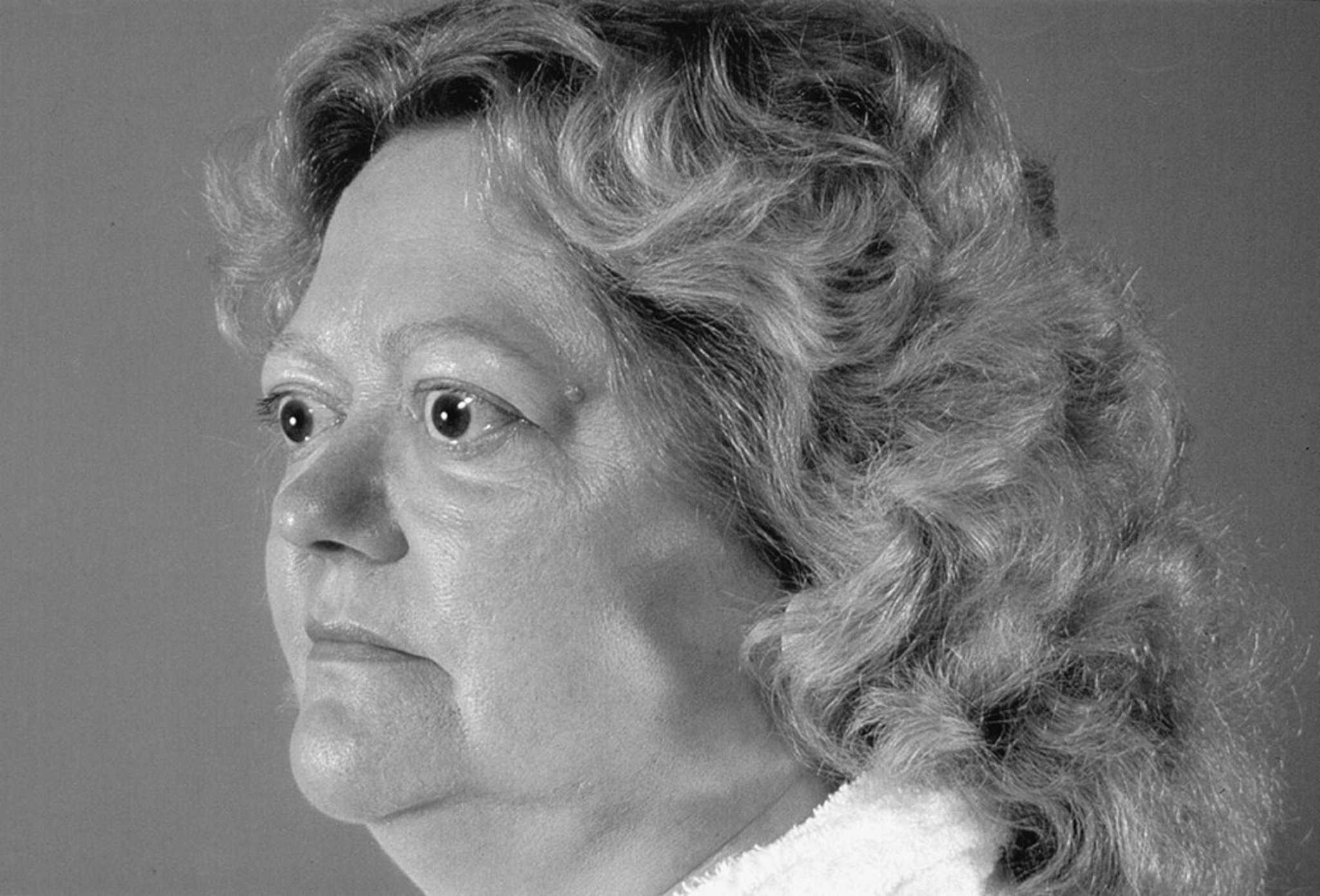 Eye Manifestations of Graves Disease—Exophthalmos