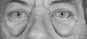 Manifestations oculaires de la maladie de Basedow, poches infraorbitaires