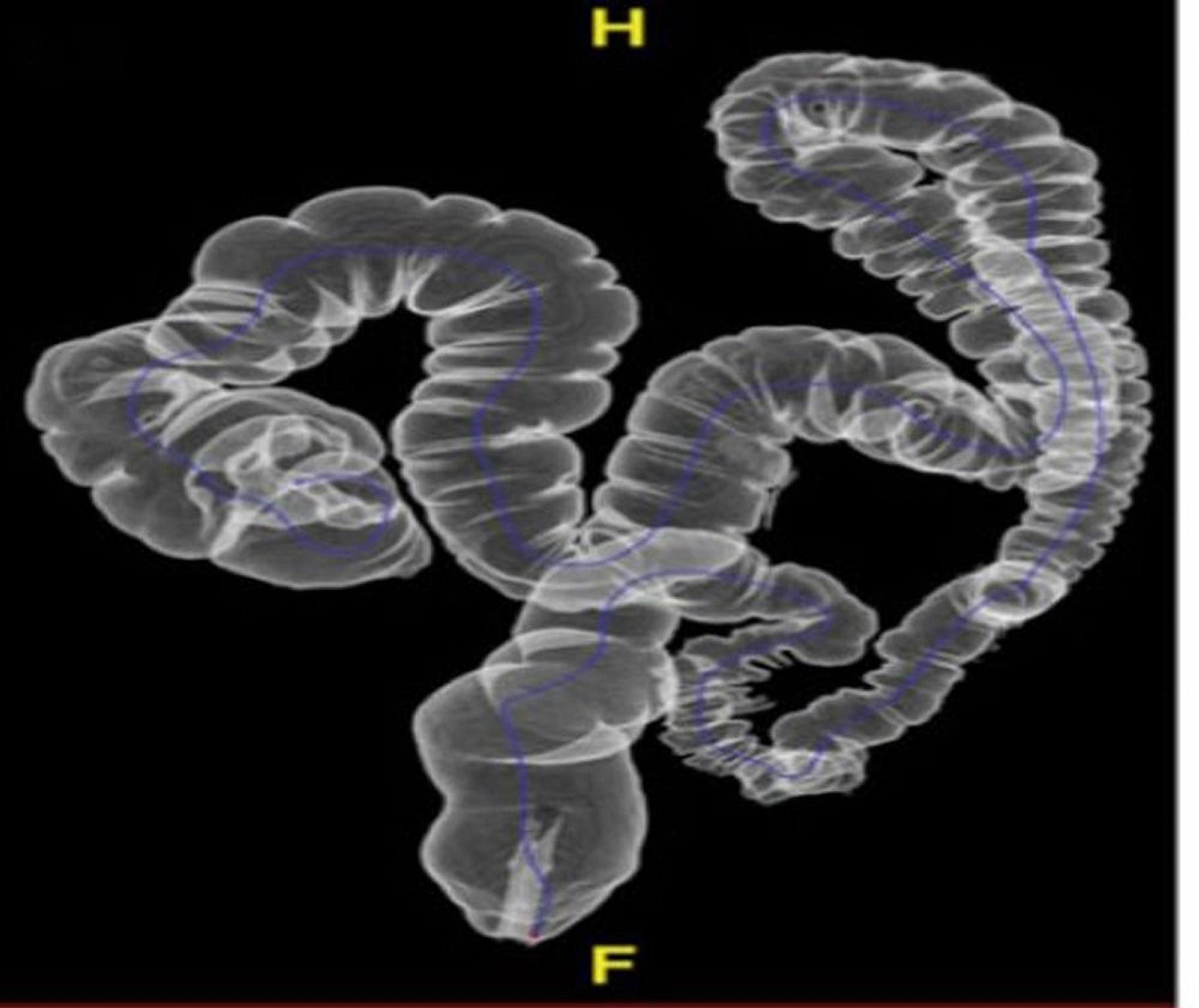 CT-Kolonographie mit normaler Anatomie