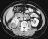 Carcinoma a cellule renali (TC con contrasto)