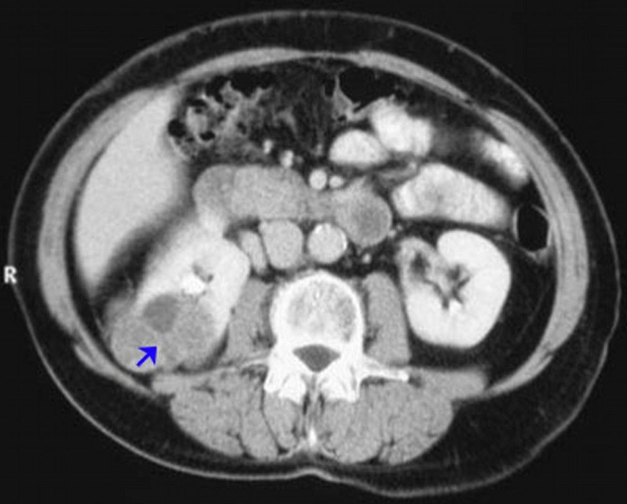 Нирковоклітинна карцинома (КТ із контрастуванням)