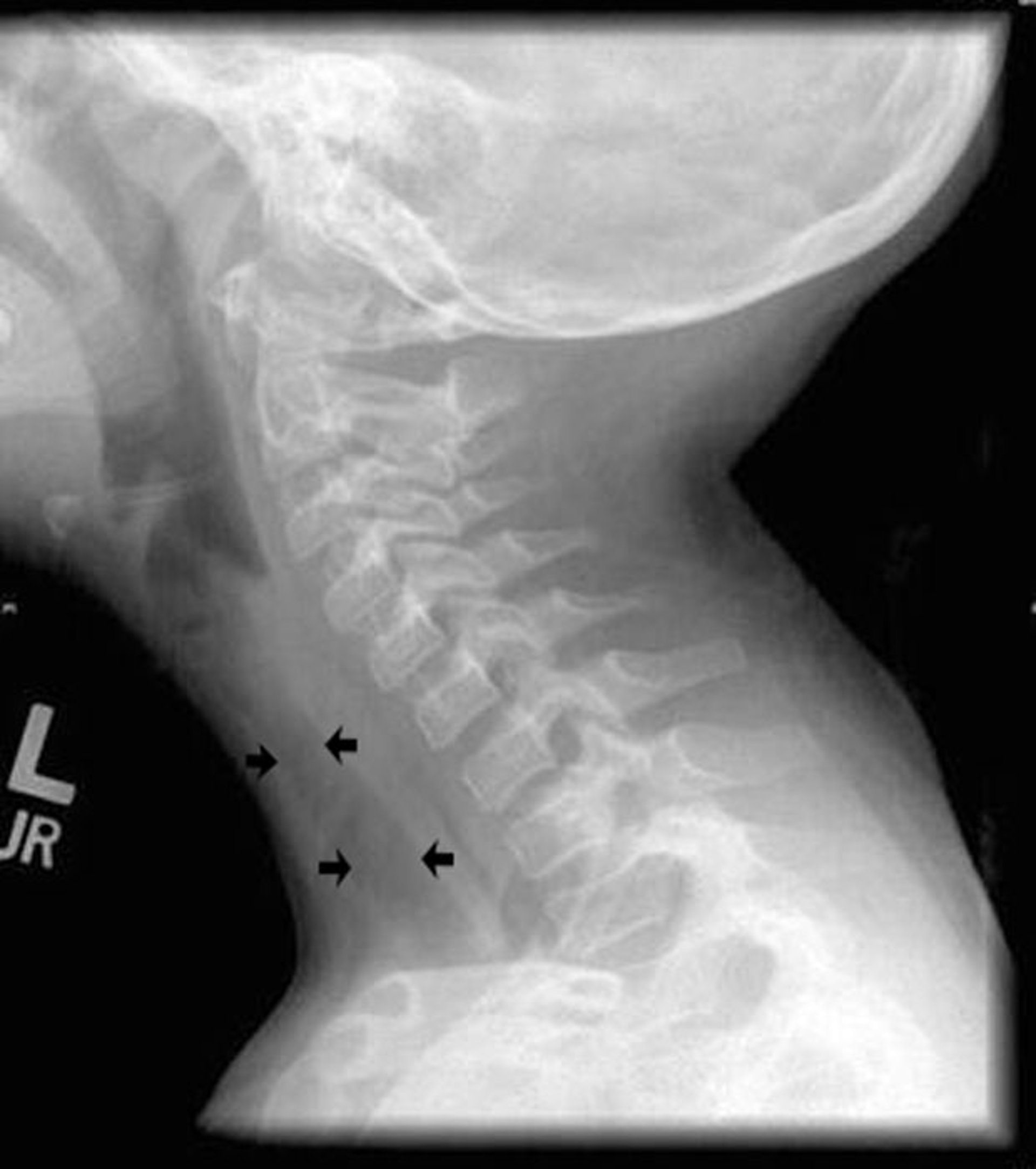Bacterial Tracheitis (Radiograph)