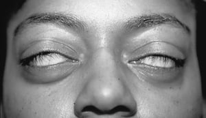Manifestações oculares da doença de Graves — incapacidade de fechar os olhos