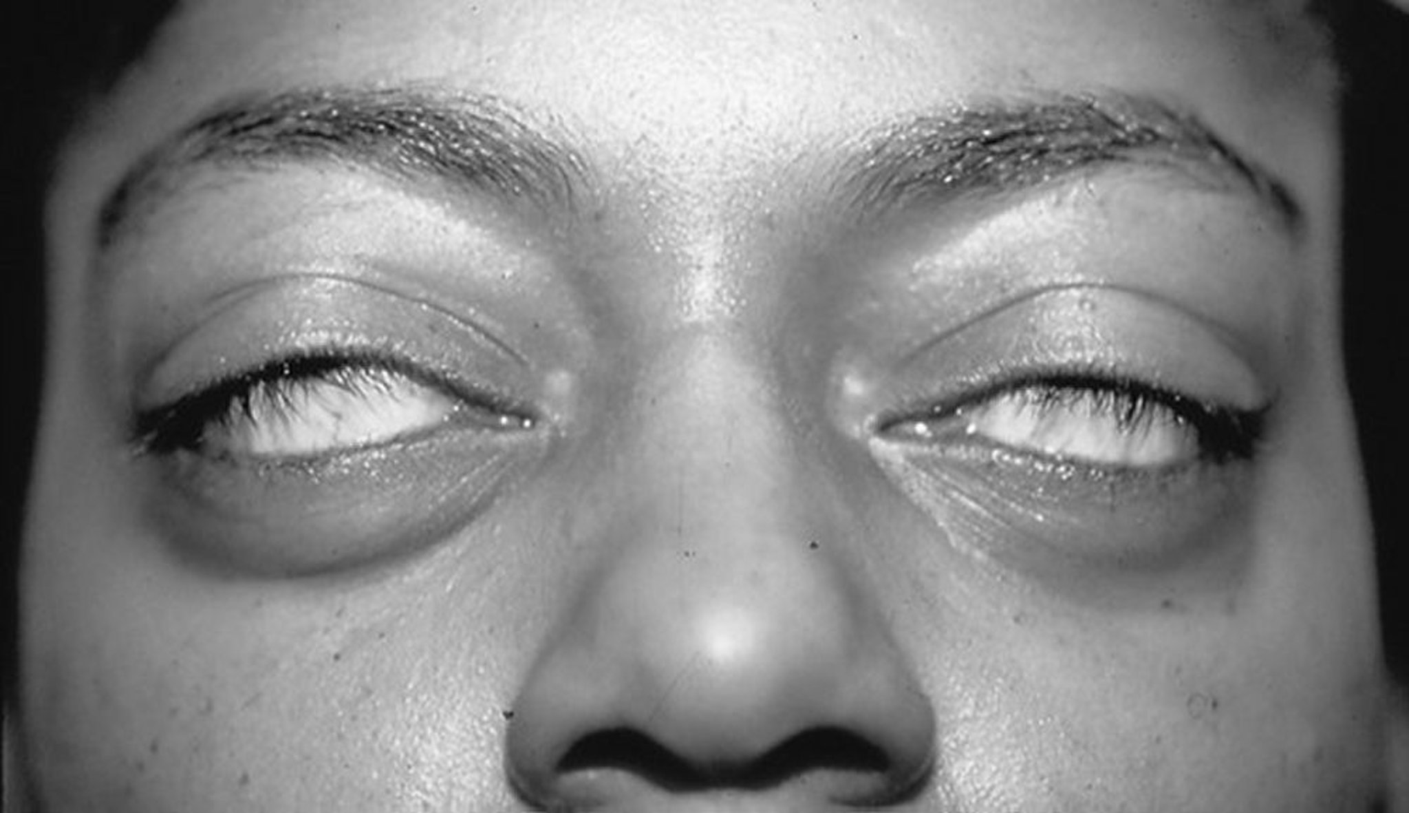 Офтальмологические проявления болезни Грейвса– неспособность закрыть глаза