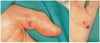 Endocarditis infecciosa (lesiones del nodo de Osler y de Janeway)