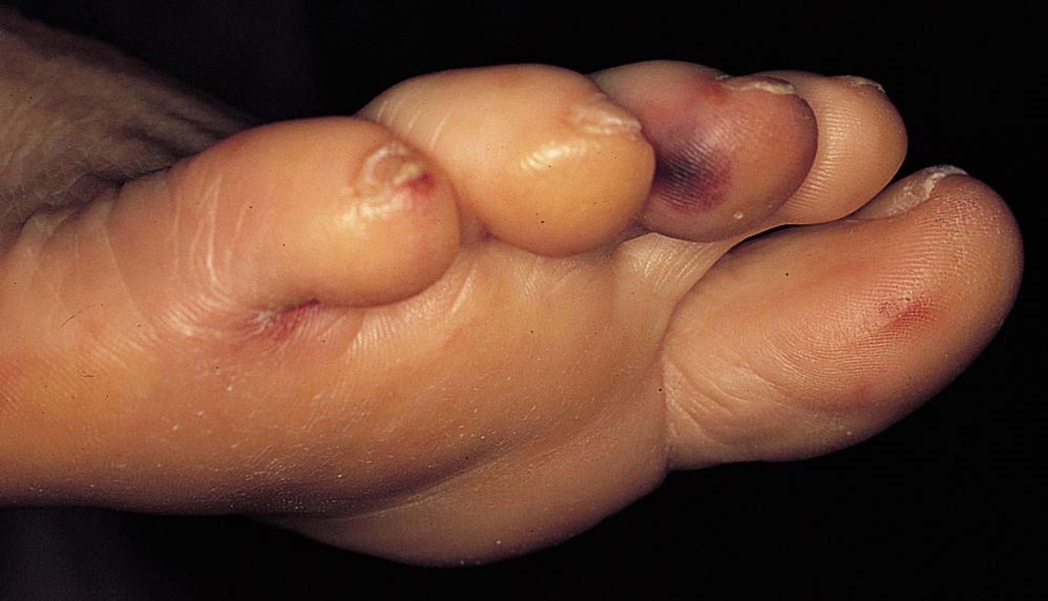 Endocardite infectieuse (nodosités d'Osler)