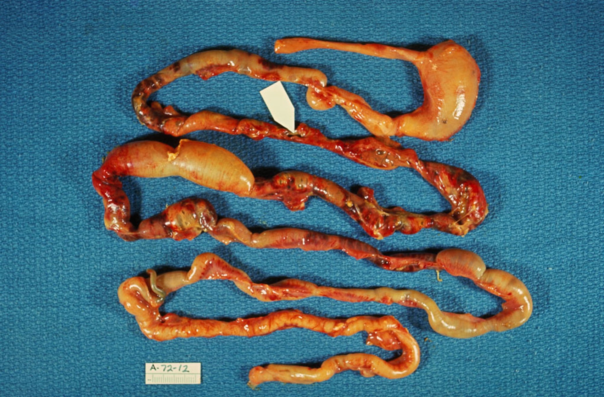 Necrotizing Enterocolitis (Autopsy Specimen)