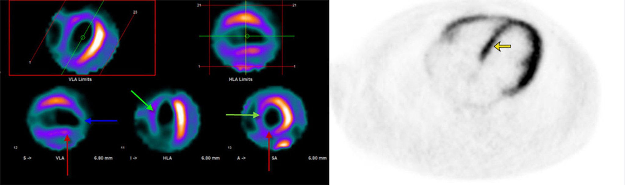 FDG-PET que muestra miocardio viable