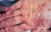 Endocarditis infecciosa (lesiones de Janeway)