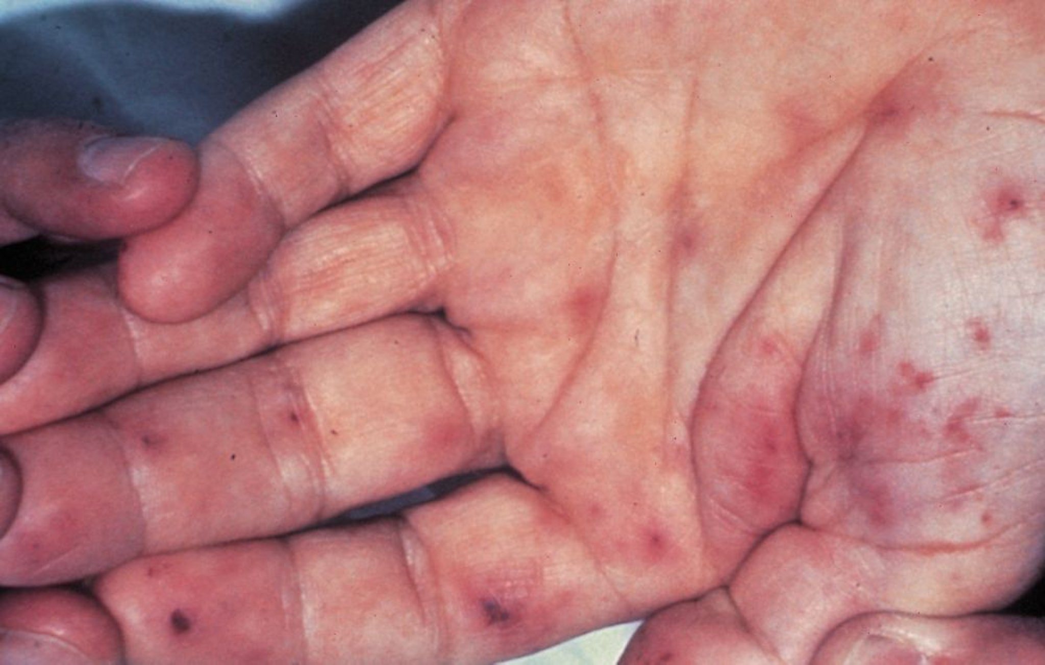 Endocardite infettiva (lesioni di Janeway)