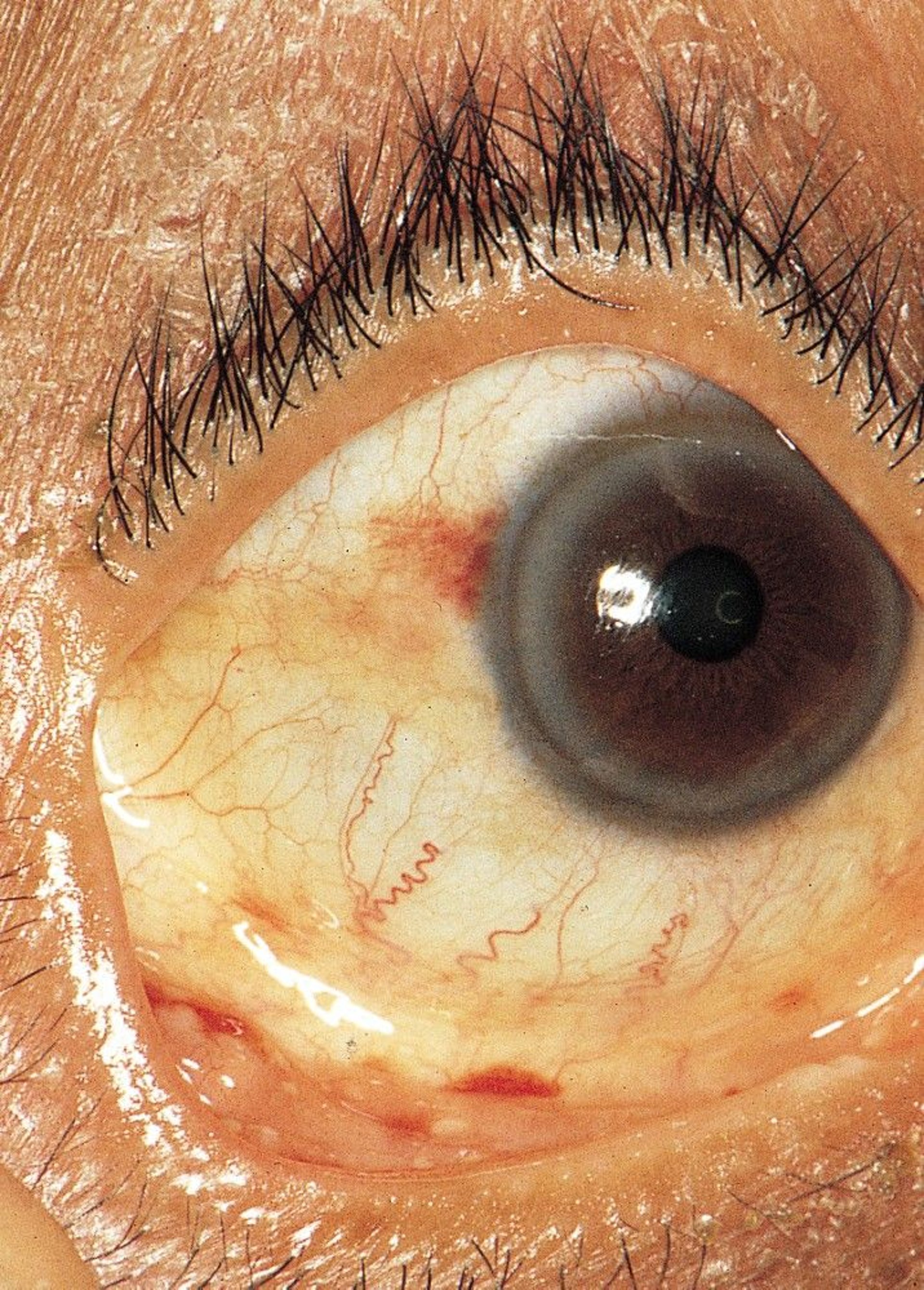 Infective Endocarditis (Conjunctival Hemorrhages)