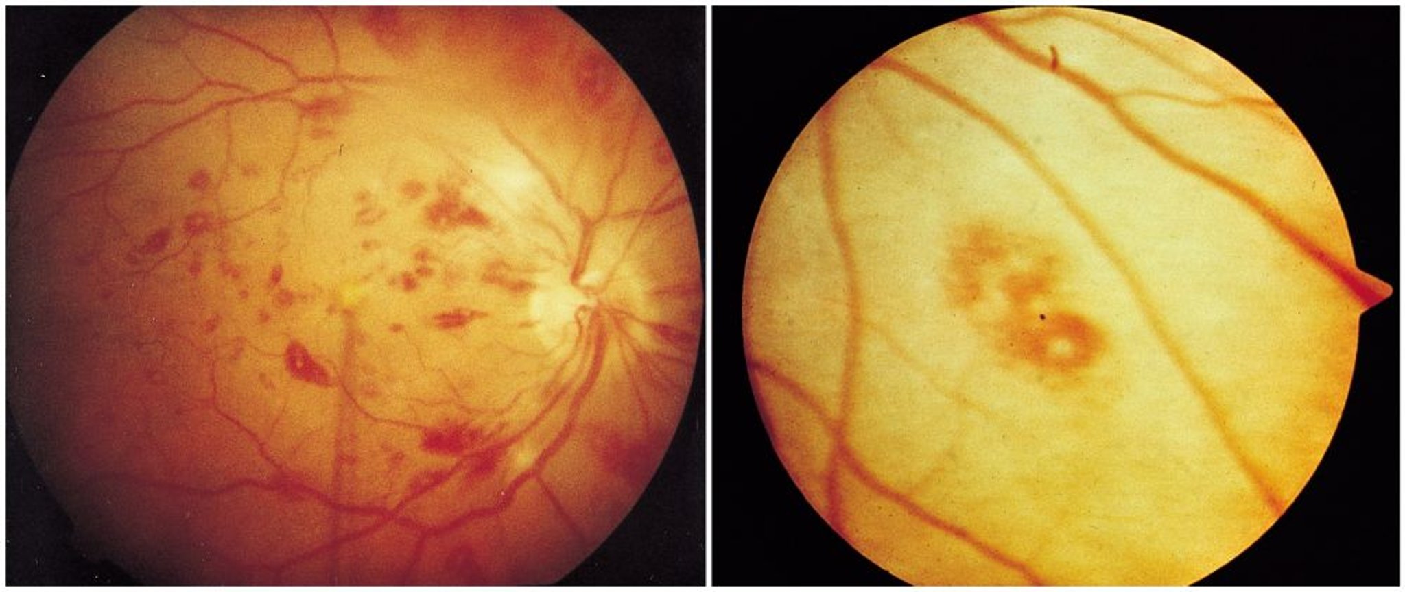 Endocarditis infecciosa (mancha de Roth)