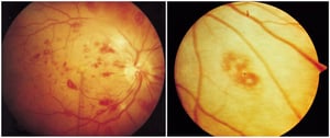 Endocarditis infecciosa (mancha de Roth)