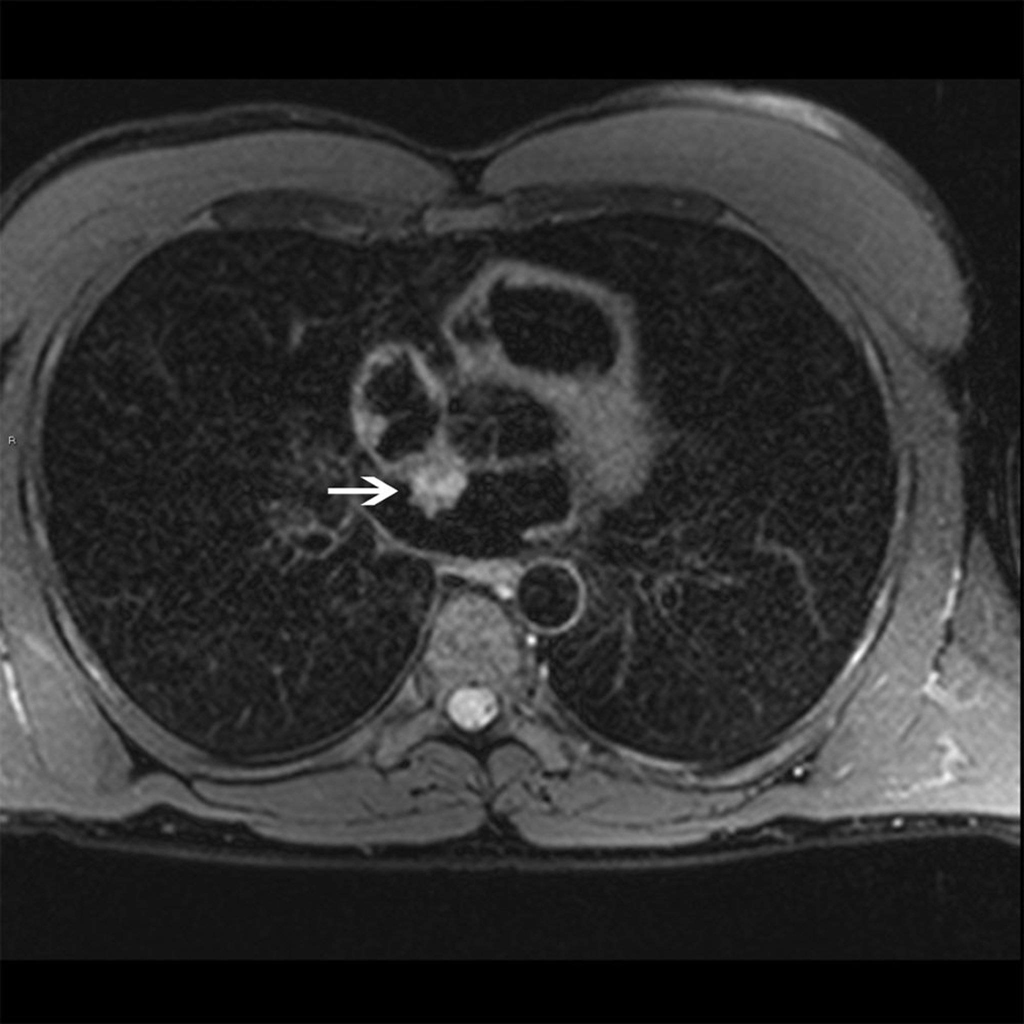 Mixoma atrial (RM cardíaca)