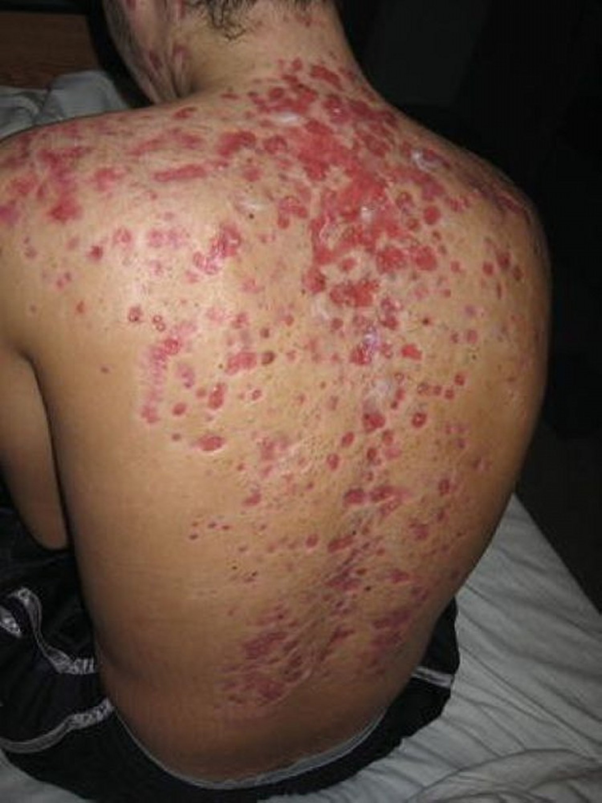 Acne Fulminans