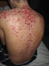 Acne fulminante