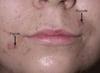Acne (papule e pustole)