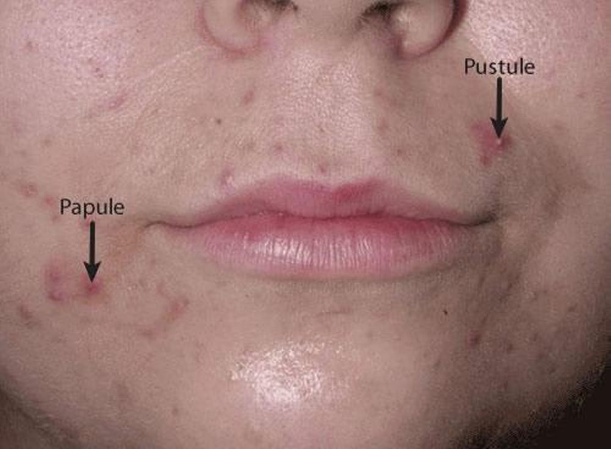 Acne (papule e pustole)