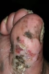 Acral-Lentiginous Melanoma (Toe)