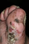 Melanoma acrale-lentigginoso (dito del piede)