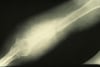 Actinomycetoma