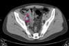 Acute Appendicitis