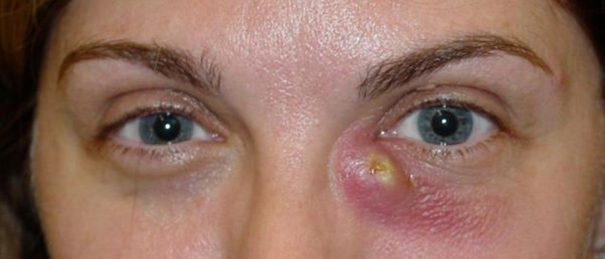 Acute Dacryocystitis with Fistula