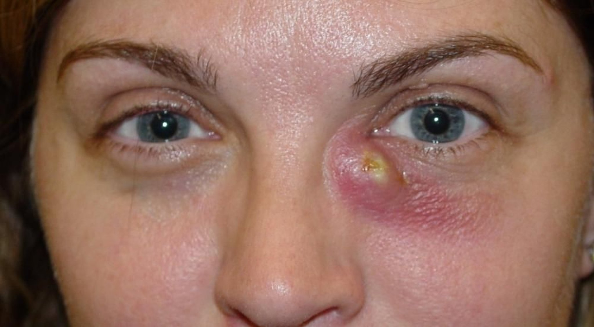 Dacriocistite acuta con fistola