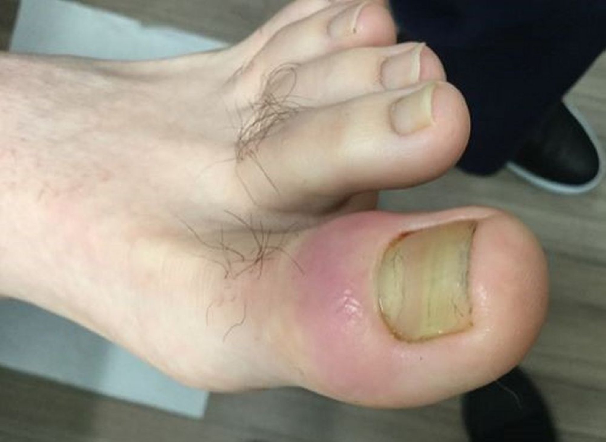 Móng đội đầu gần cấp tính