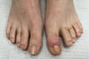 Acute Retronychia (Big Toe)