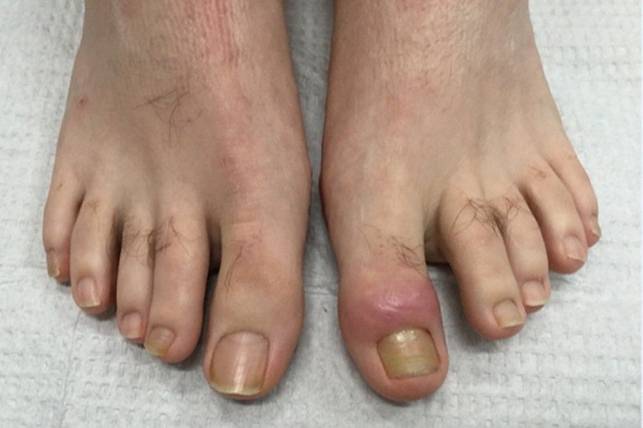 Acute Retronychia (Big Toe)