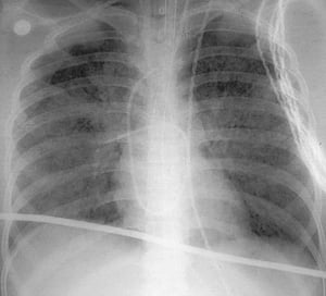 Síndrome de dificultad respiratoria aguda