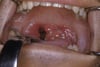 Tonsillite acuta