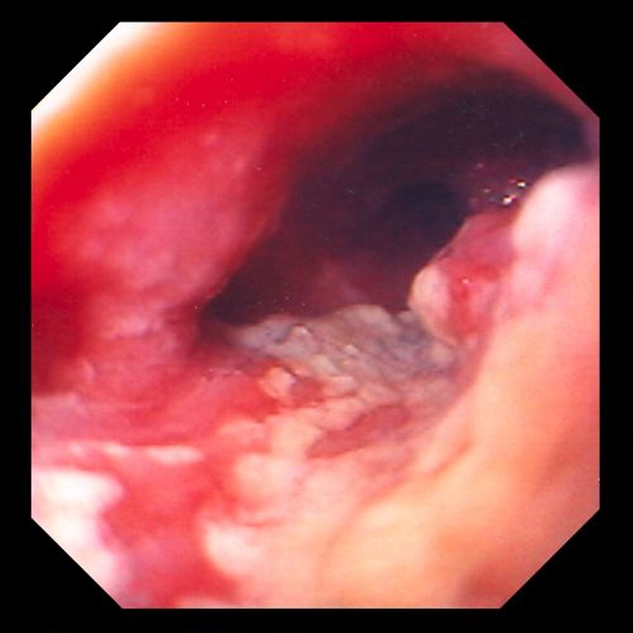 Adenocarcinoma of the Esophagus