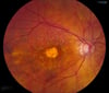Age-Related Macular Degeneration (Dry, Advanced)
