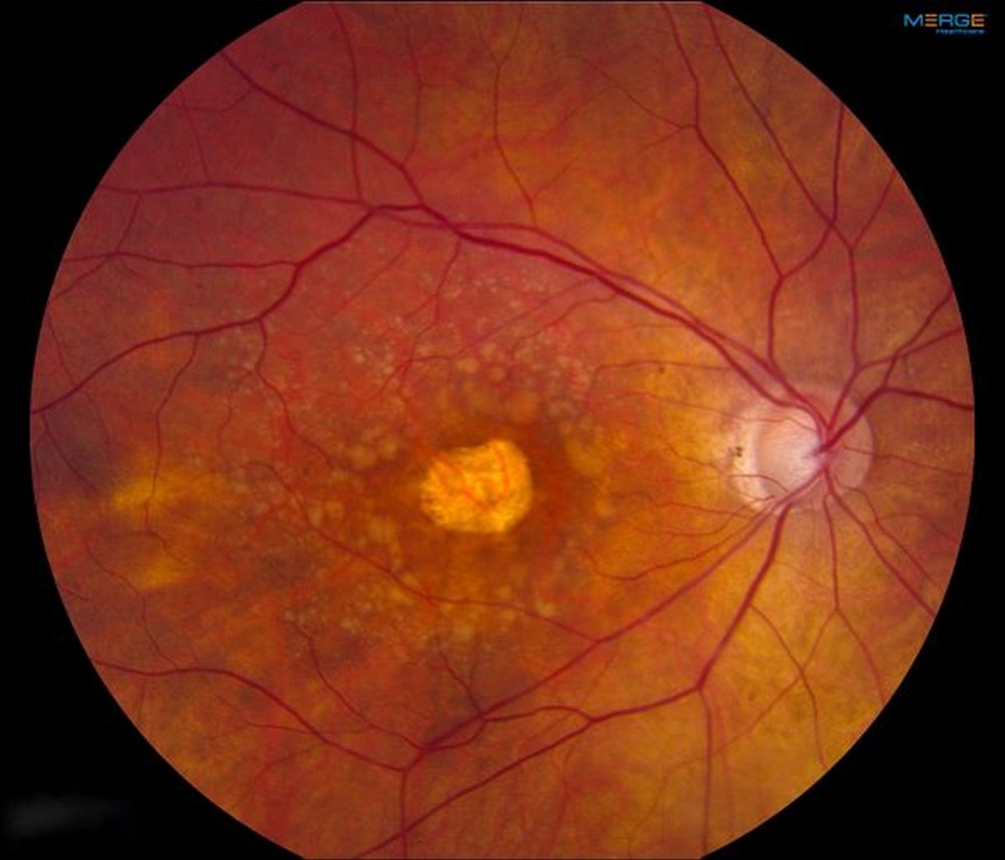 Age-Related Macular Degeneration (Dry, Advanced)