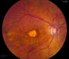 Degeneración macular relacionada con la edad (seca, avanzada)