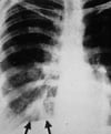 Aspergilose broncopulmonar alérgica