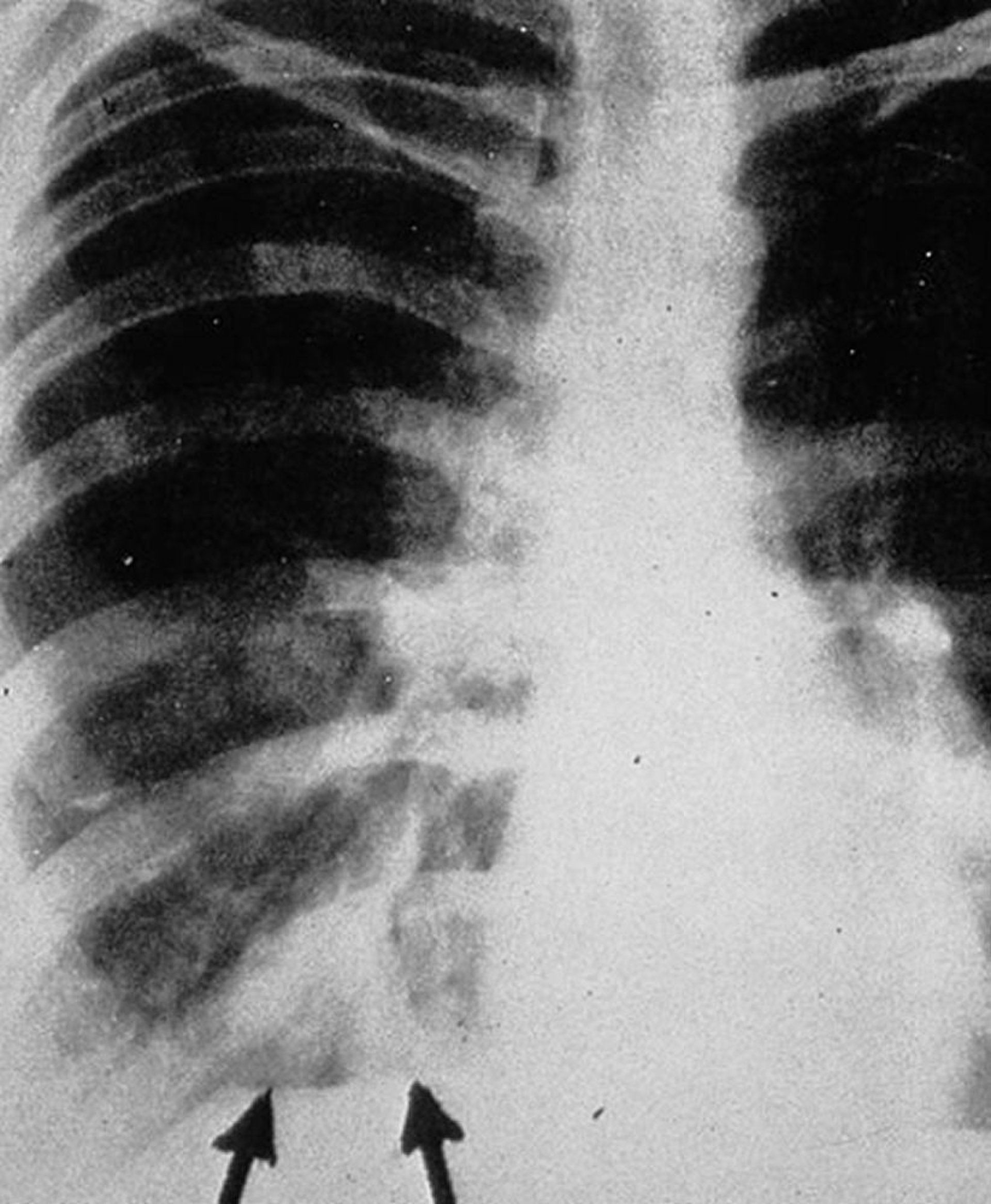 Bệnh do nấm aspergillus ở phế quản phổi dị ứng